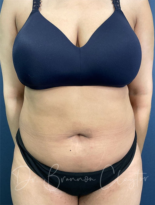 Smart Liposuction