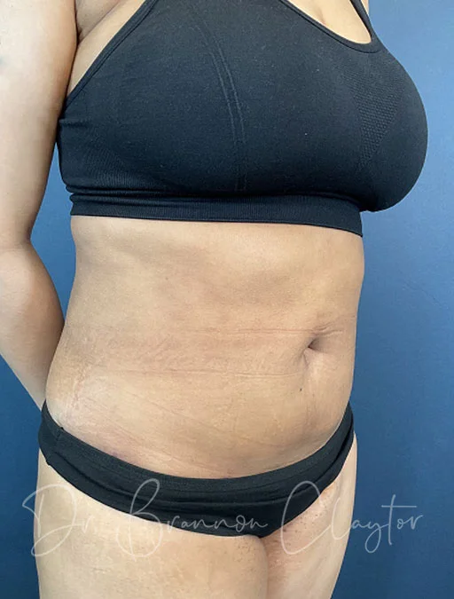 38 F After Liposuction Neck and Back