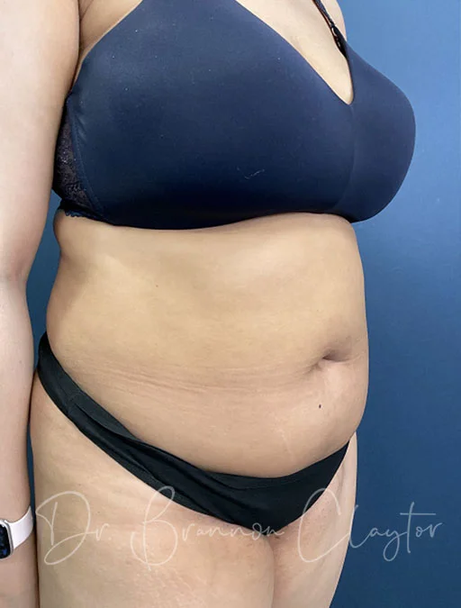 Plastic Surgery Case Study - Full Tummy Tuck and Flank Liposuction Before  Weight Loss - Explore Plastic Surgery