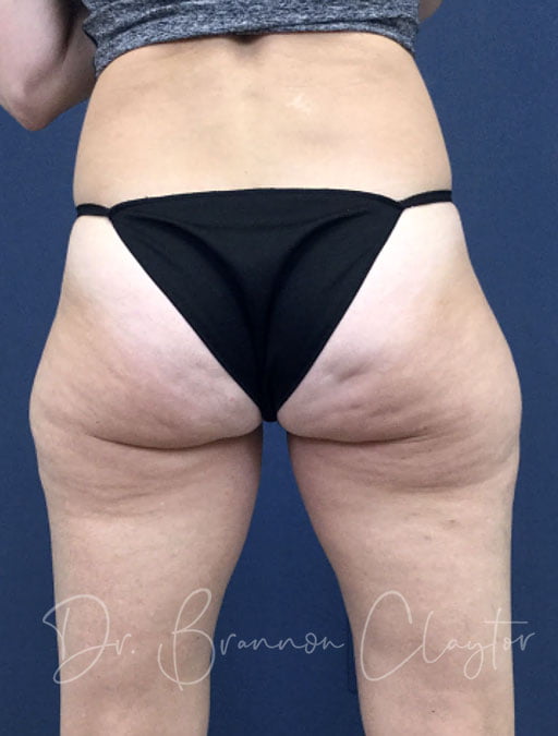 Smart Liposuction