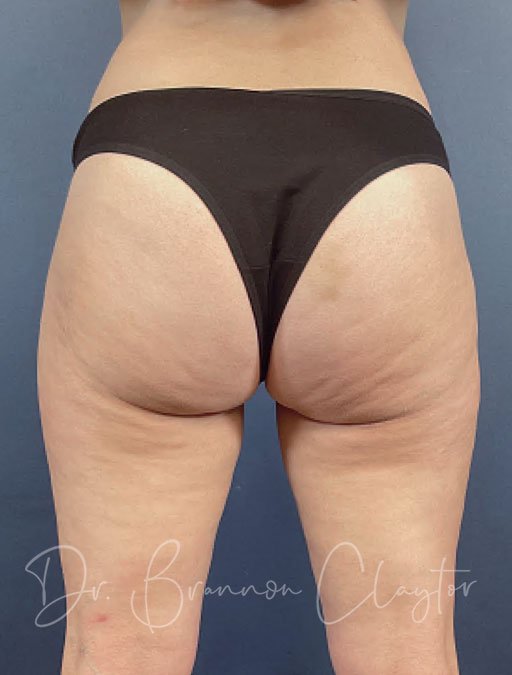 Smart Liposuction