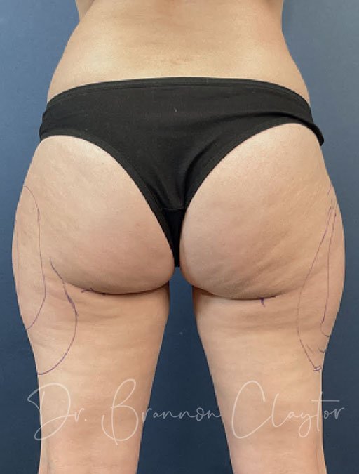 Smart Liposuction