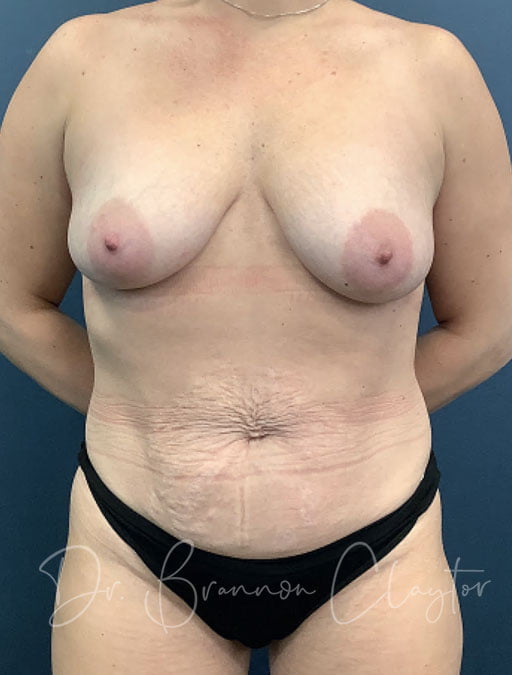 Drainless Tummy Tuck and Breast Augmentation