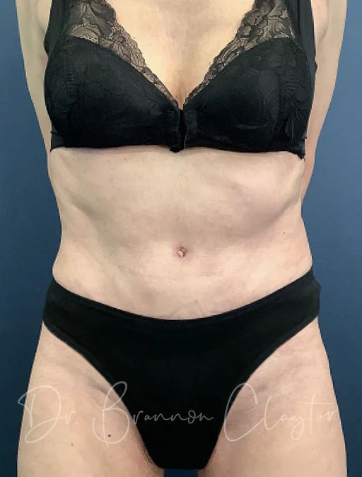 Drainless Tummy Tuck