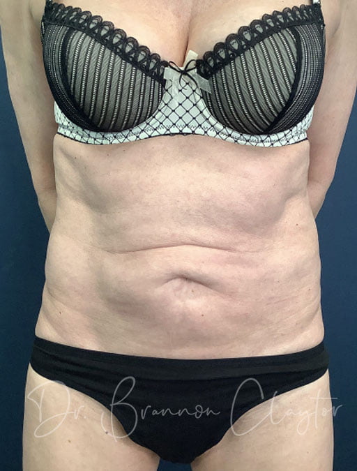 Drainless Tummy Tuck