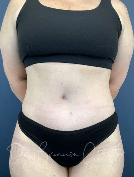 Drainless Tummy Tuck