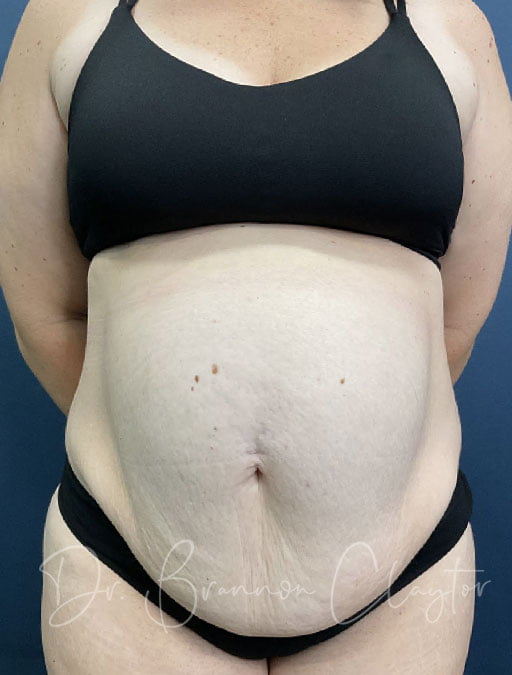 Drainless Tummy Tuck