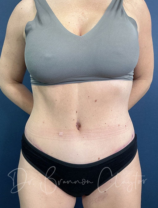 Drainless Tummy Tuck with Liposuction