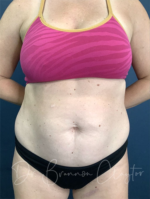 Drainless Tummy Tuck with Liposuction