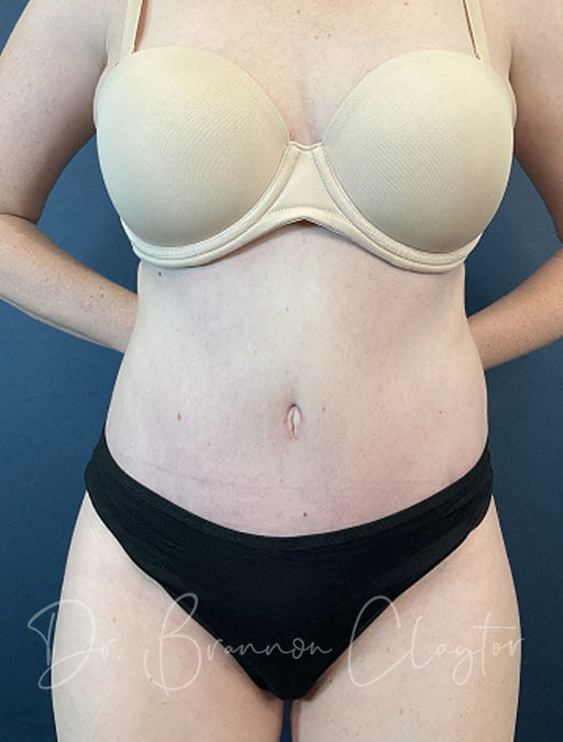 Drainless Tummy Tuck with Liposuction