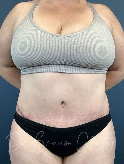 Drainless Tummy Tuck with Liposuction