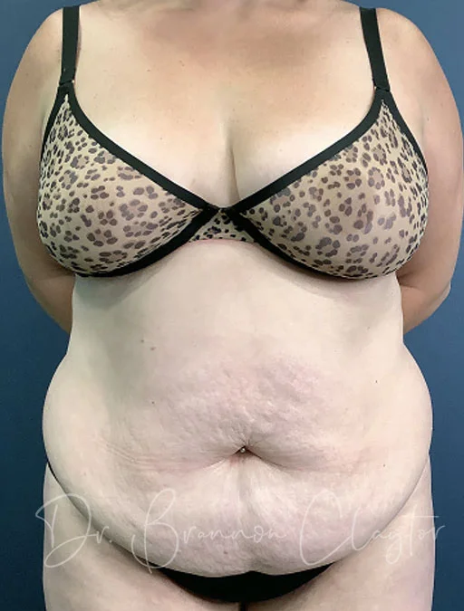 Drainless Tummy Tuck with Liposuction
