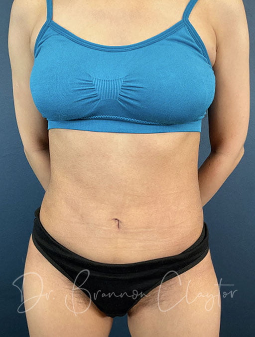 Tummy Tuck with Smart Liposuction