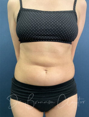 Tummy Tuck with Smart Liposuction