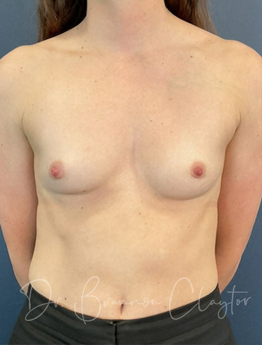 Breast Augmentation