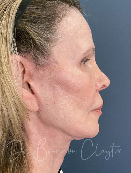 neck lift after photo 
