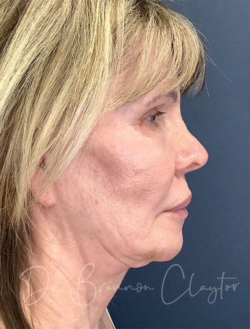 neck lift before photo 