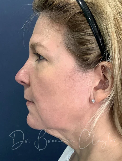 Woman with jowls, pronounced nasolabial folds, and a sagging neck before a facelift Philadelphia