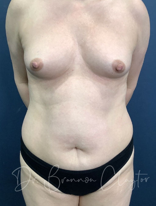 Drainless Tummy Tuck