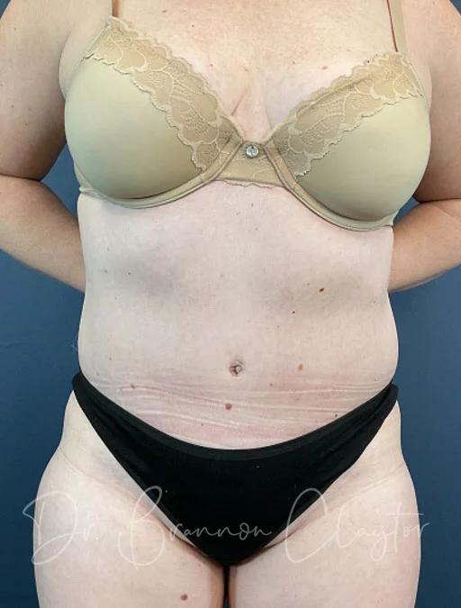 Drainless Tummy Tuck
