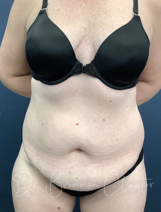 Drainless Tummy Tuck