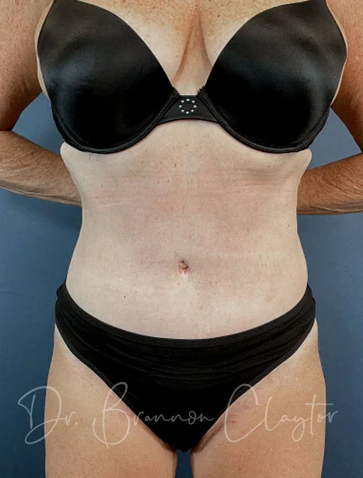 Drainless Tummy Tuck