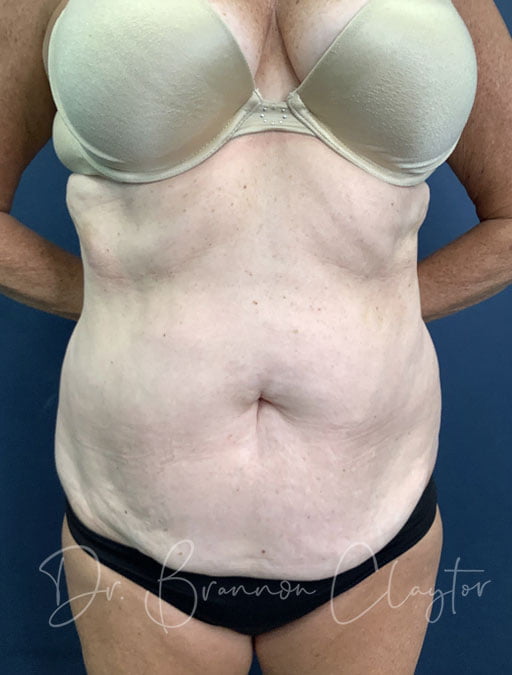 Drainless Tummy Tuck