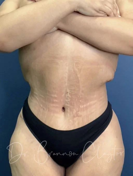 Drainless Tummy Tuck