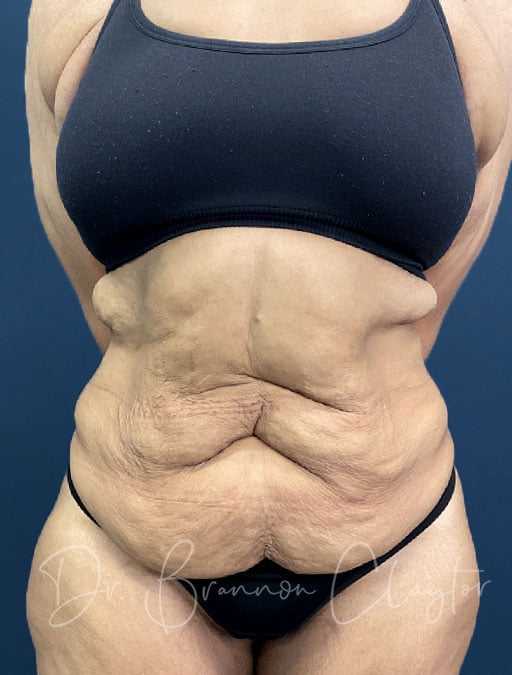 Drainless Tummy Tuck