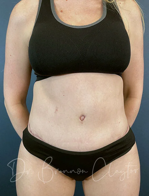 Drainless Tummy Tuck
