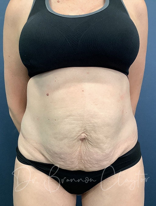 Drainless Tummy Tuck