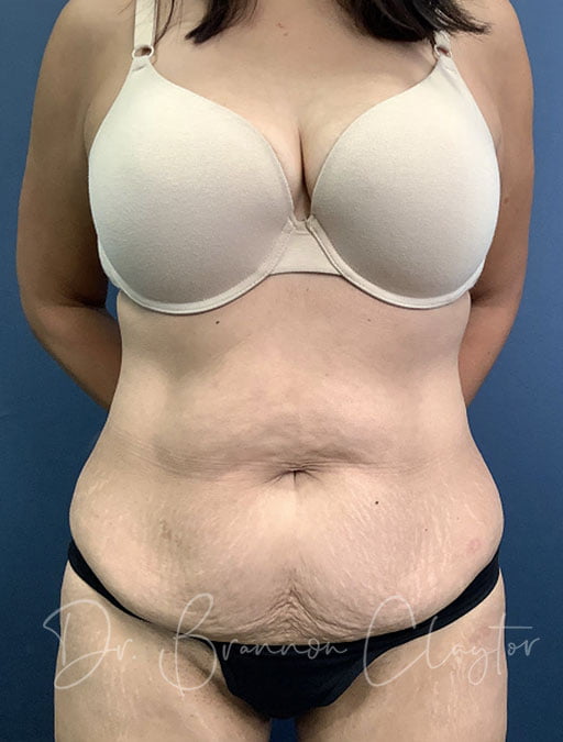 Drainless Tummy Tuck