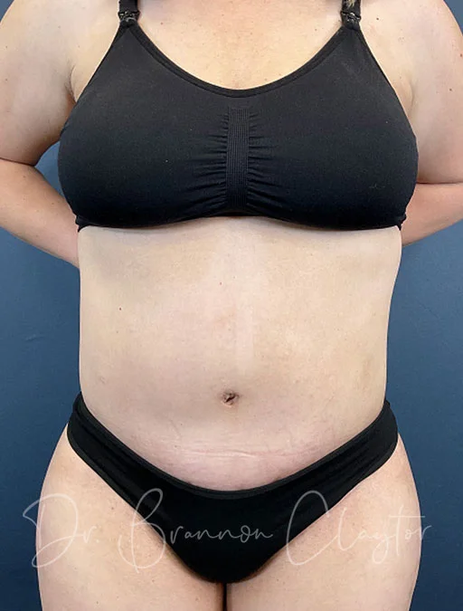 Drainless Tummy Tuck
