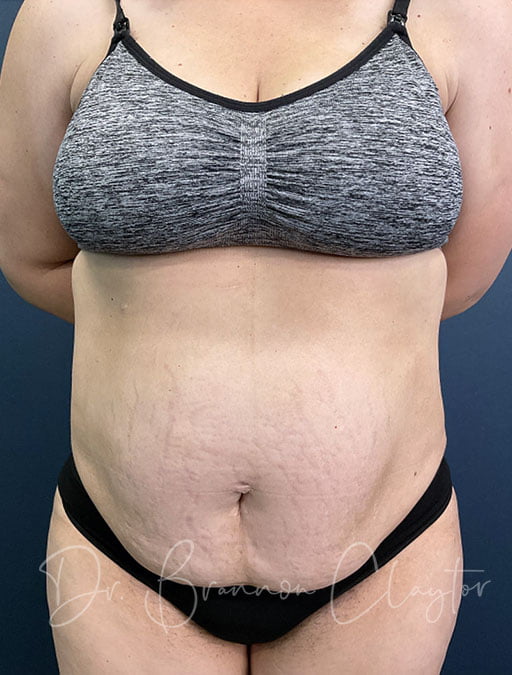 Drainless Tummy Tuck