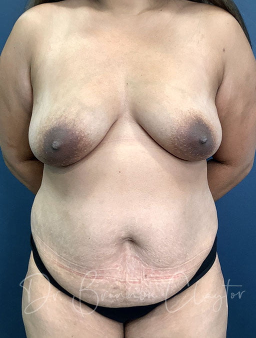 Drainless Tummy Tuck