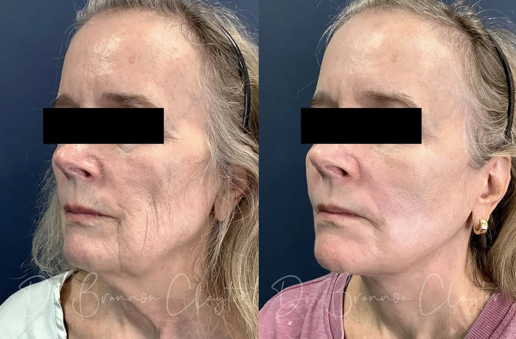 Deep plane facelift patient of Philadelphia facelift surgeon Dr. R. Brannon Claytor