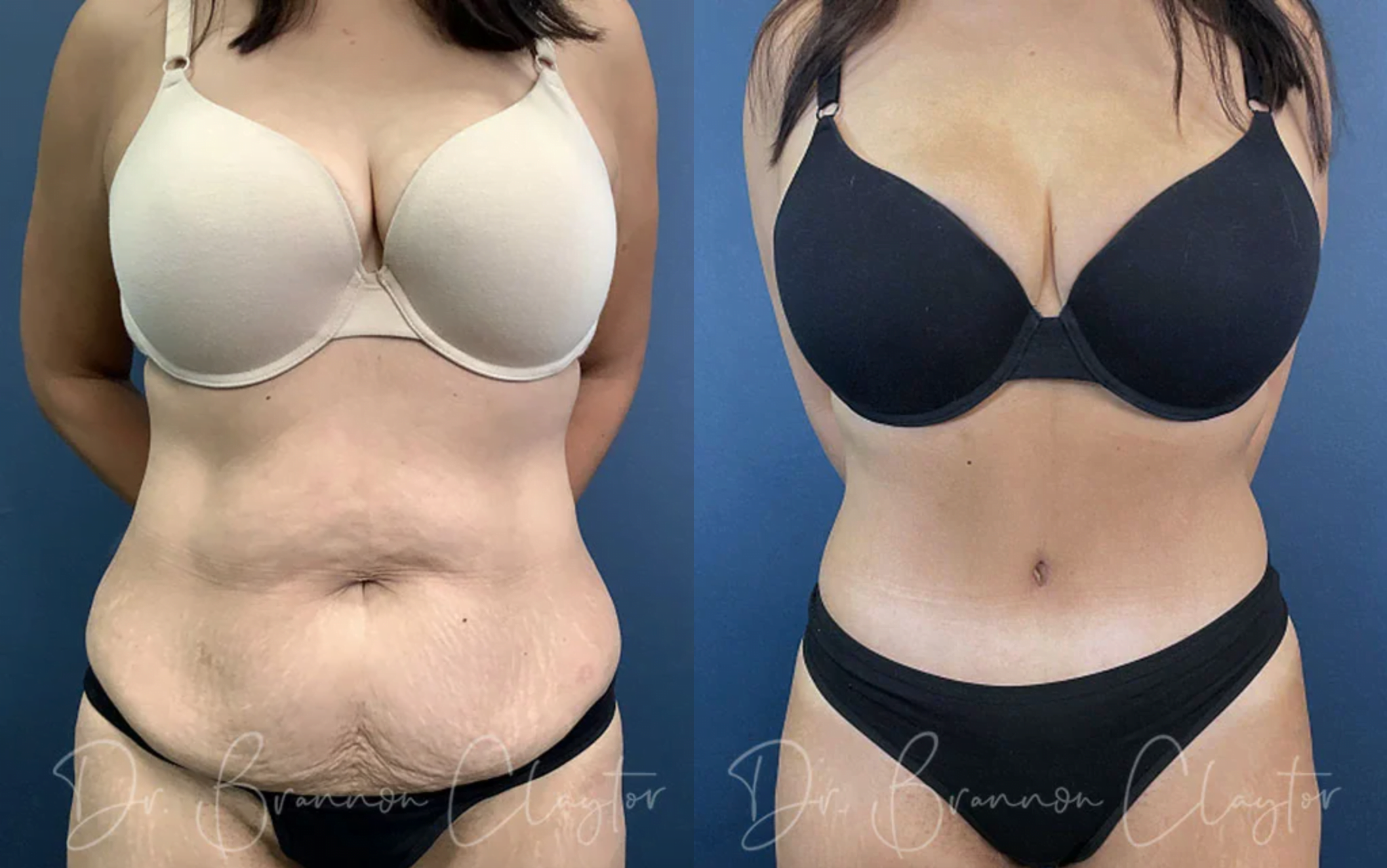 Before and after drainless tummy tuck by Dr. Claytor at Claytor Noone Plastic Surgery