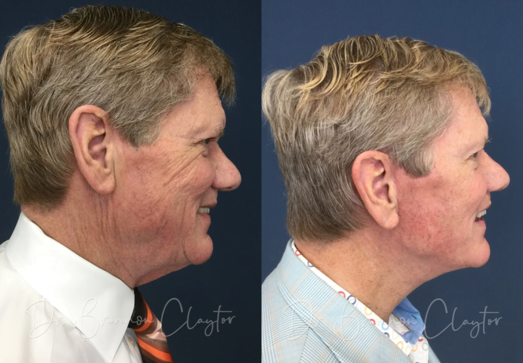 Real men's facelift patient of Dr. Claytor