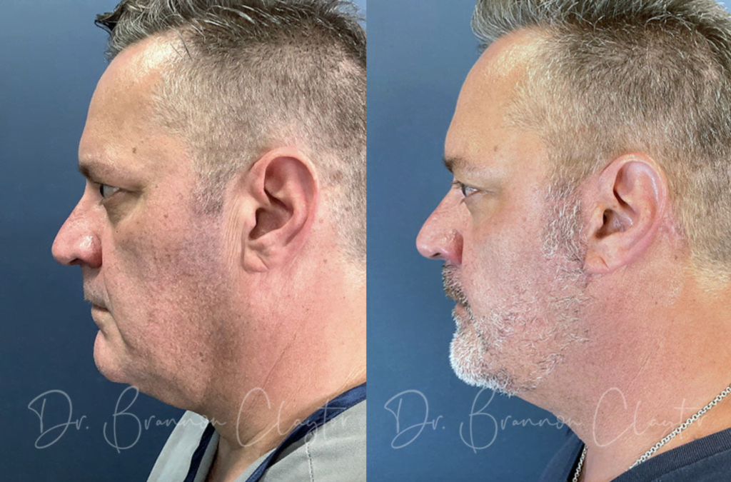 Dr. Claytor real men's facelift patient