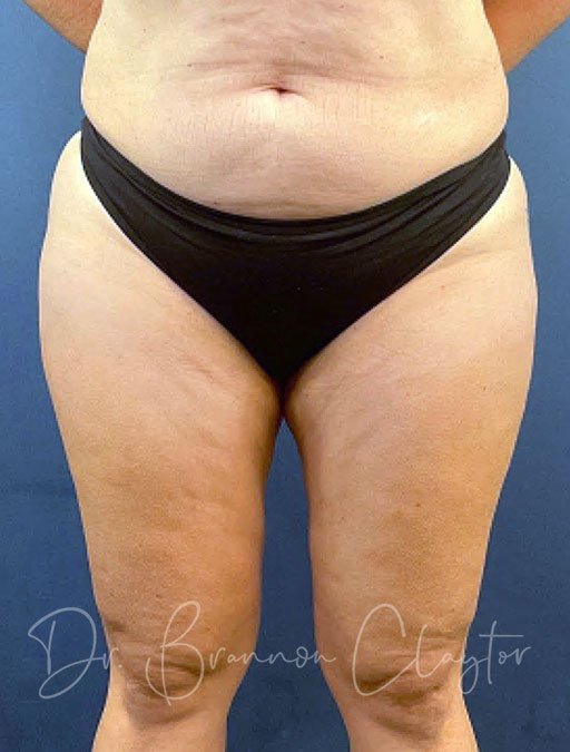 Smart Liposuction