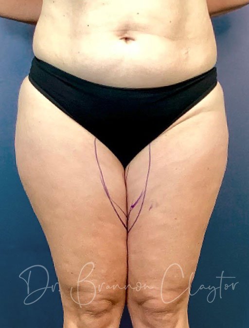 Smart Liposuction