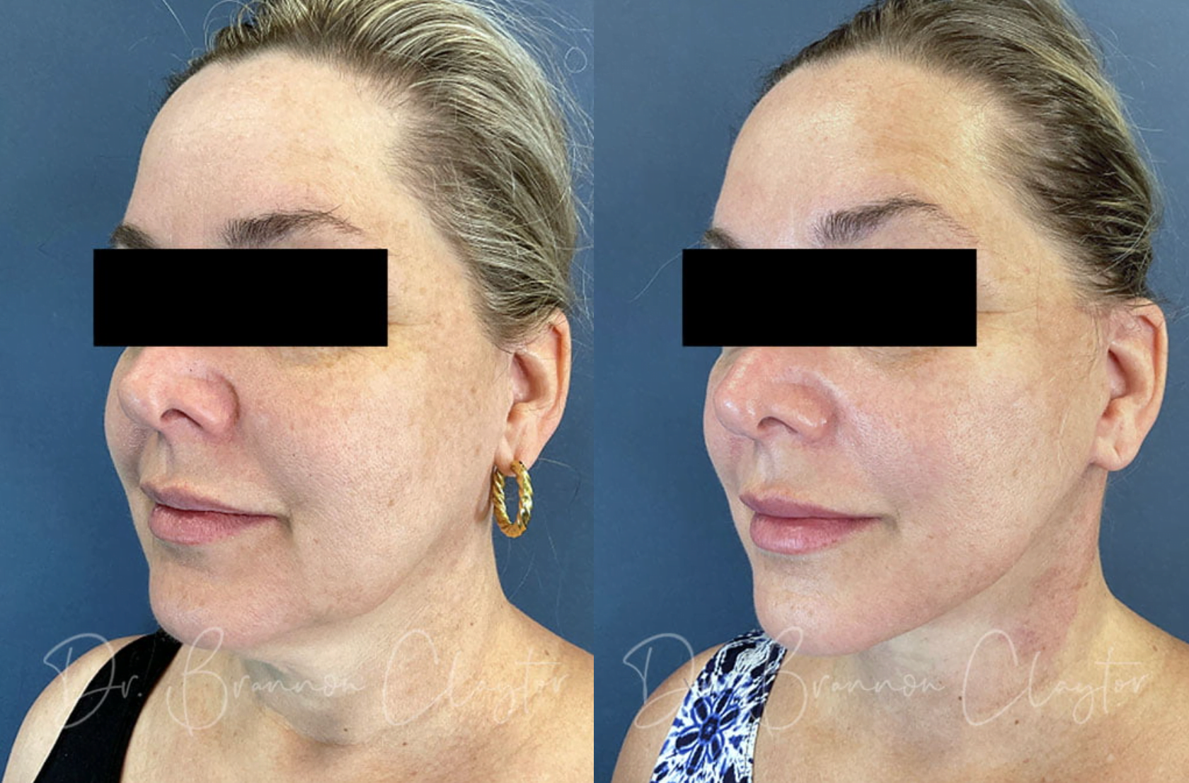 Patient shown before and after a facelift and neck lift by Philadelphia plastic surgeon Dr. R. Brannon Claytor