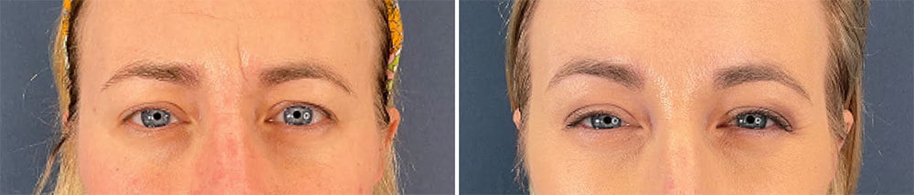 Before (left) and one week after (right) this 37 year old patient received 450 units of Daxi to her glabellar lines.