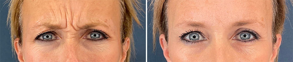 Before (left) and one week after (right) this 41 year old patient received 450 units of Daxi to her glabellar lines.