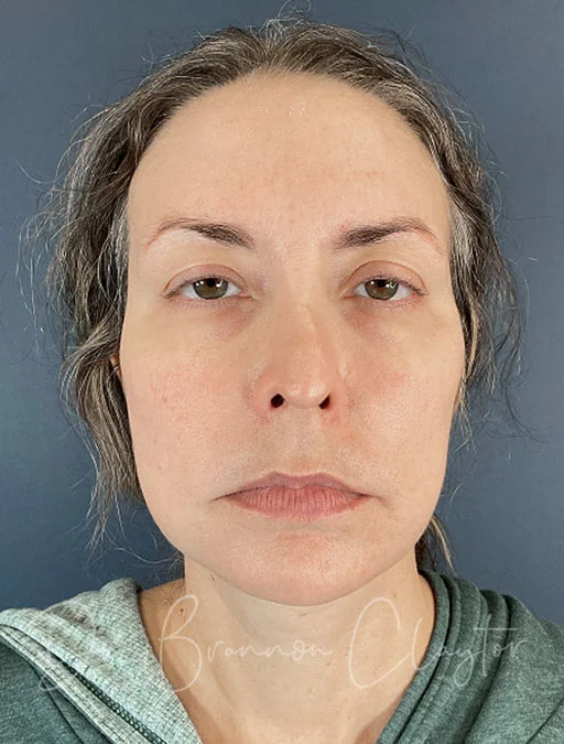 facelift-deep-plane-50646a-after