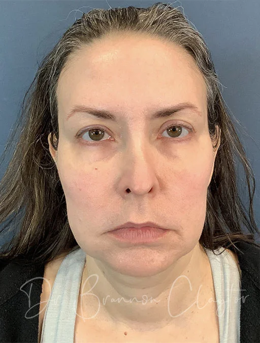 facelift-deep-plane-50646a-before