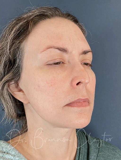facelift-deep-plane-50646b-after