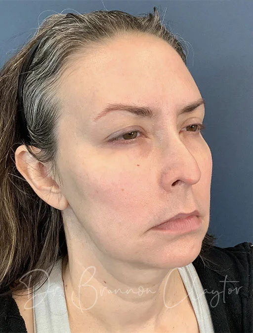 facelift-deep-plane-50646b-before