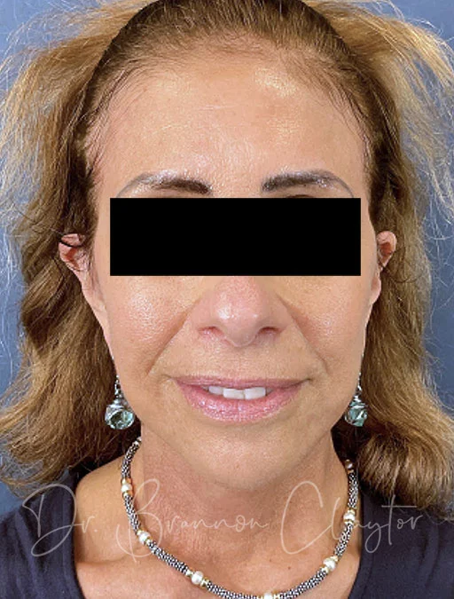 facelift-deep-plane-50780a-after