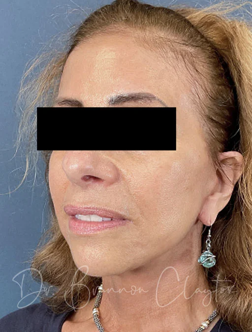 facelift-deep-plane-50780b-after